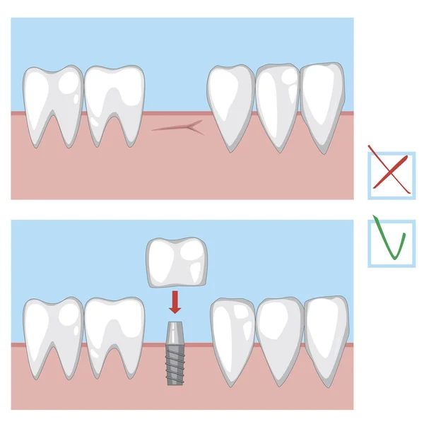 Implant zęba trzonowego przed i po dentyście, wektor do — Wektor stockowy