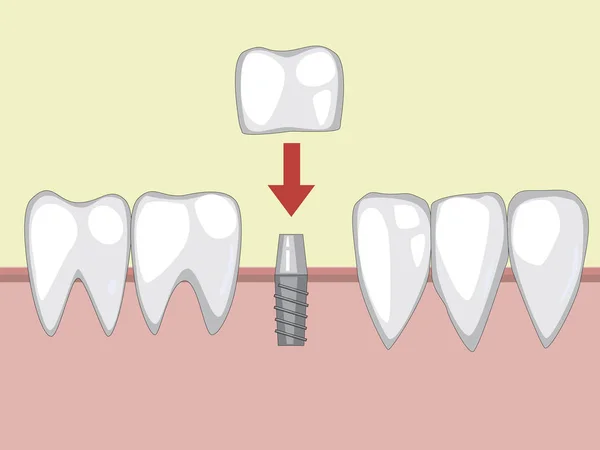 Un implante dental en un pasador de metal, una ilustración vectorial con molar — Archivo Imágenes Vectoriales