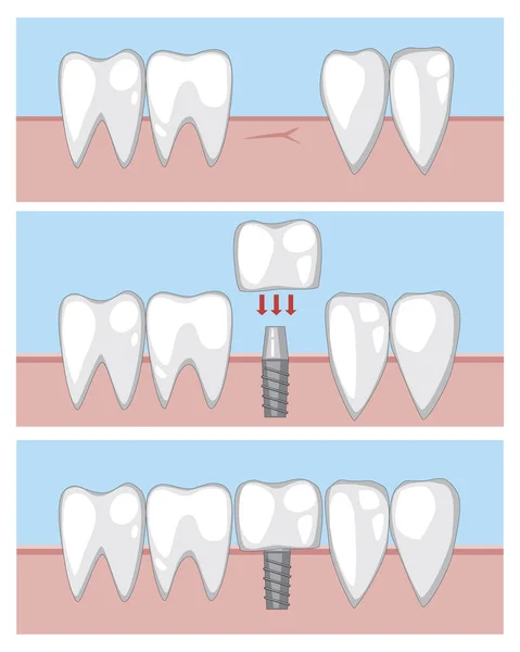 Implant trzonowy na gumie, infografika wektorowa z prozą — Wektor stockowy