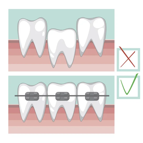 Vektorzähne mit Zahnspange auf gesundem Zahnfleisch, gesundem Bissvorsprung — Stockvektor