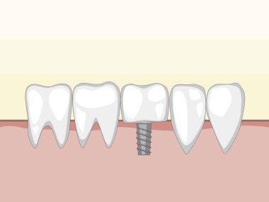Bir vektör azı dişi, kesici dişler, sivri dişler ve diş implantı sakızdaki metal bir çiviye. Diş veya ortodontik klinik için sağlıklı dişlere sahip bir illüstrasyon