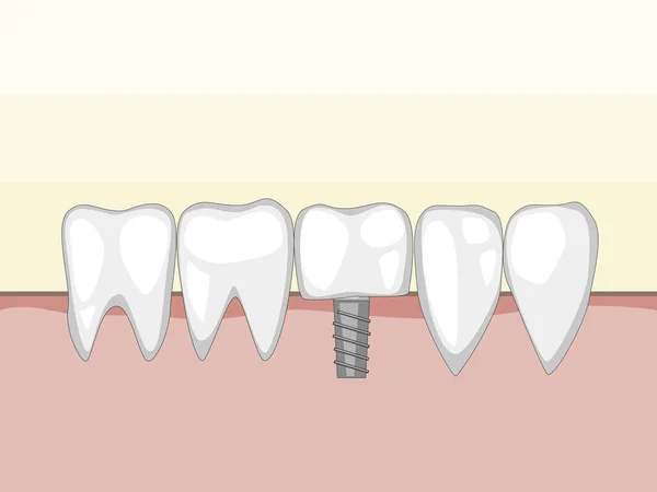 Molares Vectoriales Incisivos Colmillos Implante Dental Pasador Metal Encía Una — Vector de stock