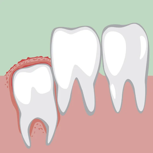 A wisdom tooth grows and the gums become inflamed and sore, a ve — Stock Vector