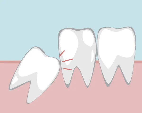 Ząb mądrości sprawia problem dla zębów trzonowych w gumie, wektor do — Wektor stockowy