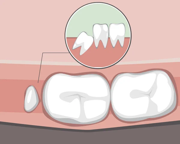Una muela del juicio crece incorrectamente e interfiere con los molares como un — Archivo Imágenes Vectoriales