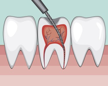 A treatment of molar pulpitis in a dental or orthodontic clinic 