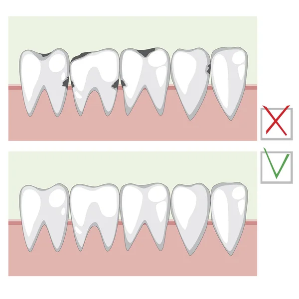 A Cáries e dentes saudáveis antes e depois de visitar um ortodon —  Vetores de Stock