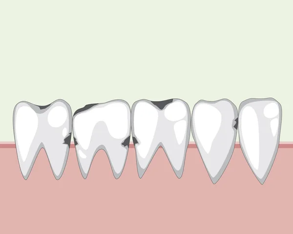 En karies på tänder med framtänder och kindtänder med tandkött, en vektor s — Stock vektor