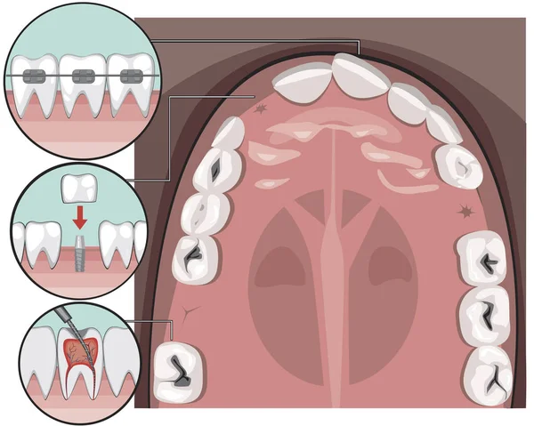 Górny widok zębów trzonowych i siekaczy na próchnicy szczęki przed wizytą — Wektor stockowy