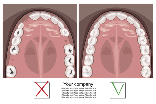 Un dente sulla mandibola guardando oltre prima e dopo il dentista o — Vettoriale Stock