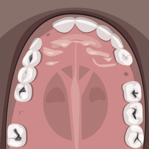 Una caries y la mandíbula de un adulto con molares vista superior antes de visitin — Vector de stock