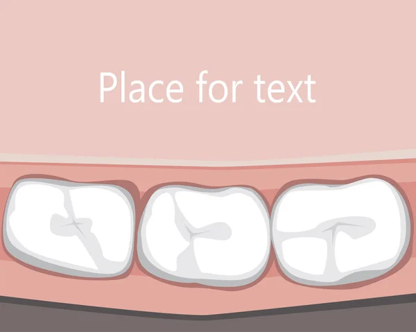Flache Zähne nach dem Besuch beim Zahnarzt oder Kieferorthopäden und Plac — Stockvektor