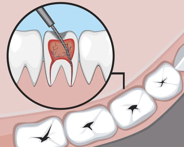 Pulpitis y molar o incisivo con caries y dolor en las encías, una ilustración de vector con un diente como concepto de tratamiento para una clínica dental u ortodóncica — Archivo Imágenes Vectoriales