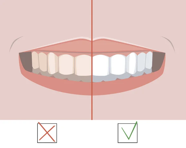 Molares antes y después del blanqueamiento, un vector plano ilustración como concepto de tratamiento dental y ortodoncia y servicios dentales — Archivo Imágenes Vectoriales