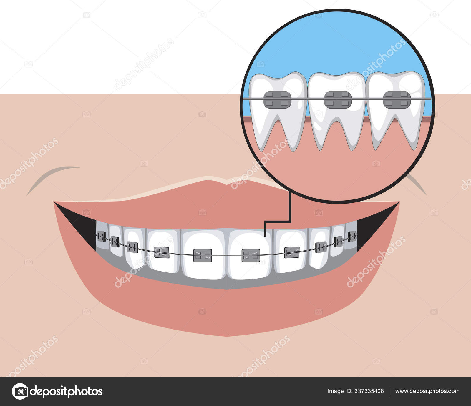 Ortodoncia brackets imágenes de stock de arte vectorial | Depositphotos Ortodoncia brackets imágenes de stock de arte vectorial | Depositphotos