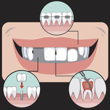  Caries, diş eksikliği, implant ve diş telleri ile bir sorun konsepti olarak gülümseme, siyah bir arka plan ve tedavi vektör stoku tasarım için bir diş veya ortodontik kliniği