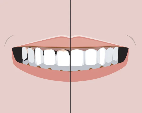 Зубы с кариесом и пульпитом и здоровой улыбкой как концепция лечения в стоматологической или ортодонтической клинике, векторная иллюстрация запасов зубов и резцов до и после лечения — стоковый вектор