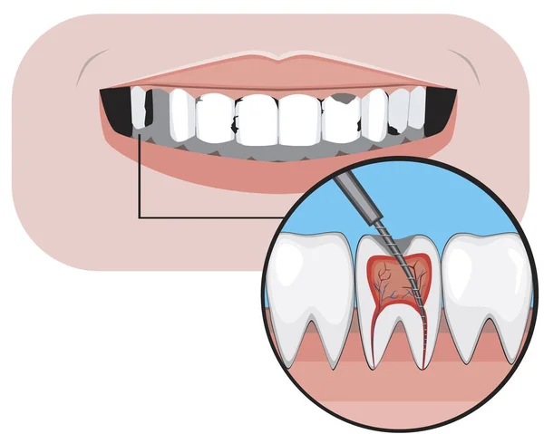 Una caries y pulpitis con una sonrisa como concepto de tratamiento en una clínica odontológica u ortodóncica, una ilustración de stock vectorial con averías con molares e incisivos — Vector de stock