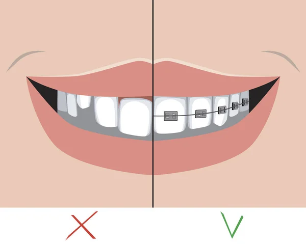 Metal diş telleri ve çarpık dişler, diş veya ortodontik klinikte tedavi konsepti olarak gülümseme ile, azı dişi ve kesici dişlerle ilgili problemleri olan vektör stoğu çizimi, tedavi öncesi ve sonrasında