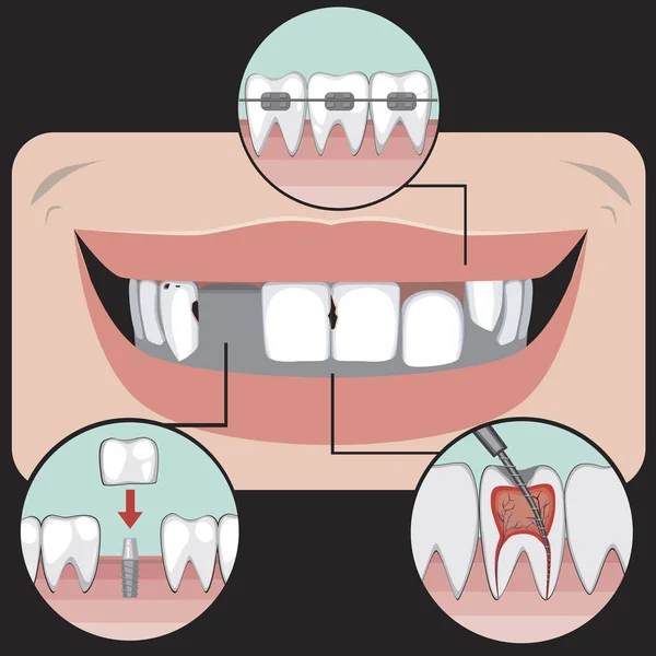 Un sorriso con carie, mancanza di denti, impianti e bretelle come concetto di problemi con molari e incisivi, illustrazione vettoriale su sfondo nero e trattamento in una clinica dentistica o ortodontica per la progettazione — Vettoriale Stock