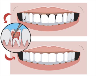 Dişçiden önce ve sonra sağlıklı dişleri olan bir gülümseme. Azı dişlerinin pulpiti ve ortodontik hizmetlerin tasarımı veya reklamı için kesici dişlerin bir tedavi konsepti olarak vektör stok illüstrasyonu