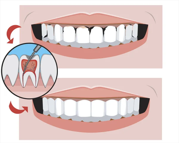 Dişçiden önce ve sonra sağlıklı dişleri olan bir gülümseme. Azı dişlerinin pulpiti ve ortodontik hizmetlerin tasarımı veya reklamı için kesici dişlerin bir tedavi konsepti olarak vektör stok illüstrasyonu