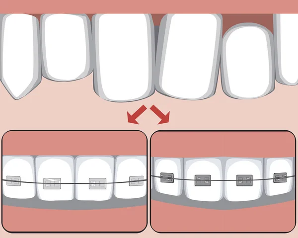 Çarpık Bir Diş Metal Seramik Diş Teli Isırık Düzeltme Konsepti — Stok Vektör