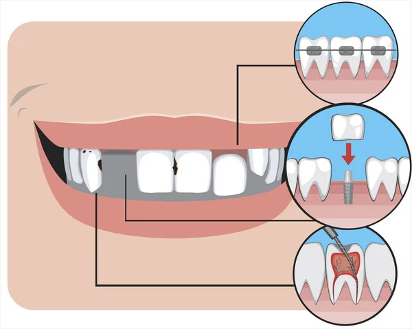 Una Sonrisa Antes Después Visitar Ortodoncista Dentista Ilustración Stock Vectorial — Archivo Imágenes Vectoriales