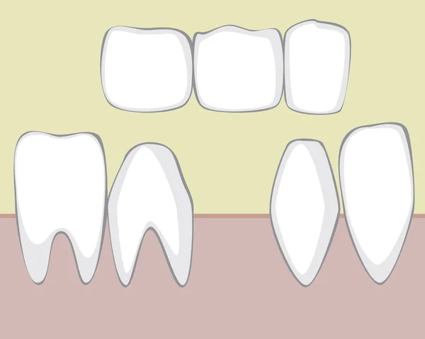 Puente Ortodoncia Molares Cortadores Posky Vector Stock Concepto Con Dientes — Archivo Imágenes Vectoriales