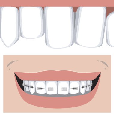 Eğri azı dişleri ve üst çenesinde diş telleri olan kesici dişler sağlıklı bir gülümseme. Dişli düz vektör stok çizimi ve ortodontik ve diş hizmetleri konsepti olarak.