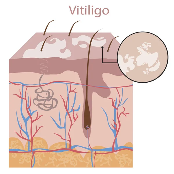 Derisi Vitiligo Ile Kaplı Dermatolojik Sorunlarla Melanin Ile Ilgili Bir — Stok Vektör