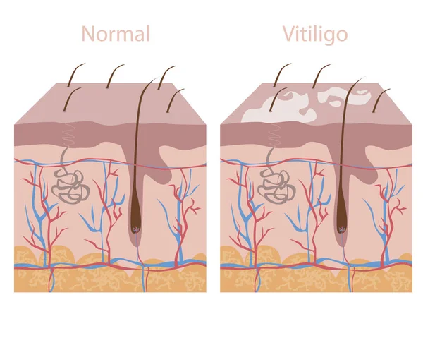 Vitiligo Depigmentasyonlu Normal Deri Deri Düz Vektör Stok Illüstrasyonu Sağlıklı — Stok Vektör