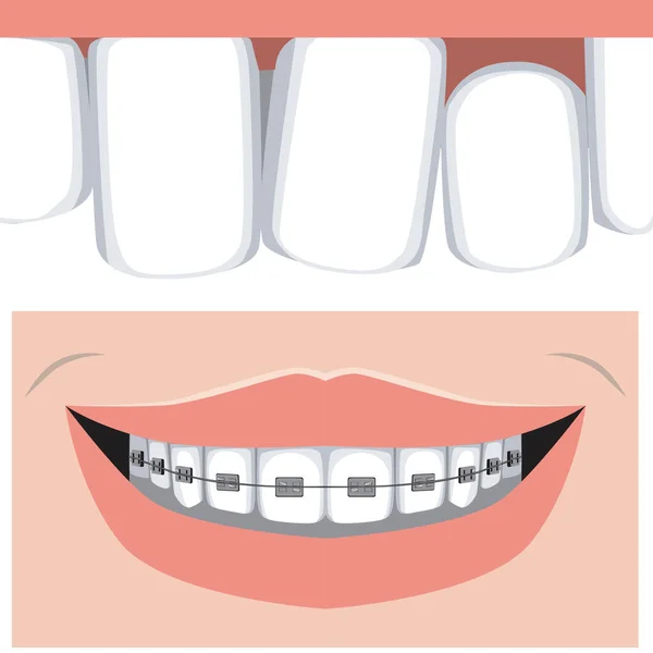 Fogak Malocclusion Felső Állkapocs Egy Mosoly Fogszabályzóval Lapos Vektor Állomány — Stock Vector