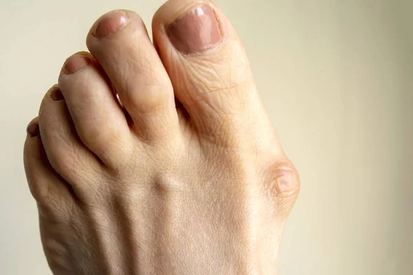 Hallux Valgus Big Abnormal Foot Bone Bunion Big Toe Female — Stock Photo, Image