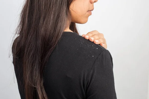 Women Having Dandruff Hair Shoulder — Stock Photo, Image