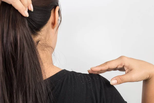 Women Having Dandruff Hair Shoulder — Stock Photo, Image