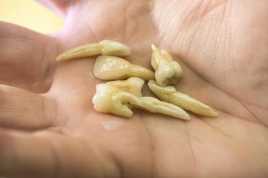 Diş Protez / yapay diş