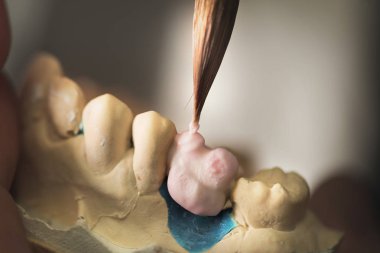 Diş Protez / yapay diş