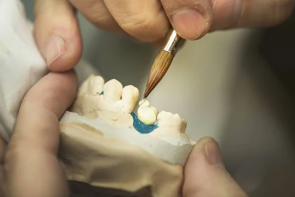 Dental Prosthesis / Artificial Tooth