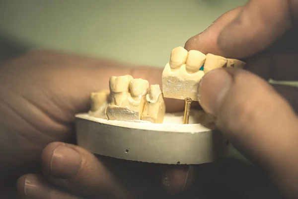 Οδοντικών προθέσεων / τεχνητό δόντι — Φωτογραφία Αρχείου