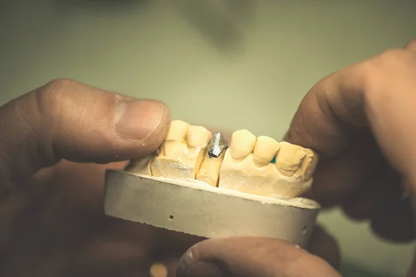 Prótesis dental / diente artificial — Foto de Stock