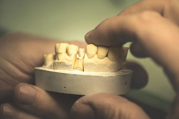 Prótese dentária / dente artificial — Fotografia de Stock