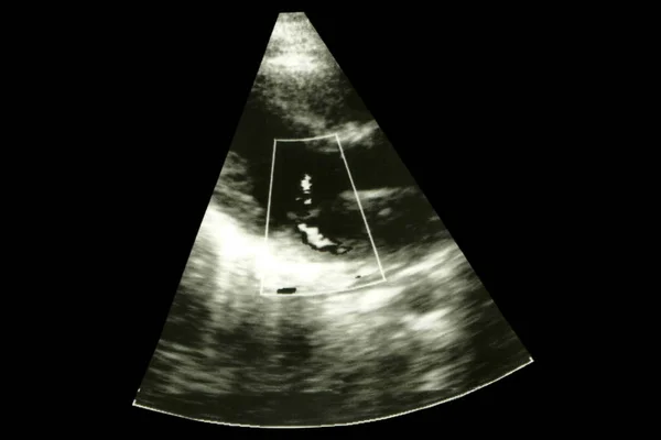 Wazig Hartultrasoon Beeld Scherm Met Foetale Echocardiografie Symbool Diagnostiek Gezondheidszorg — Stockfoto