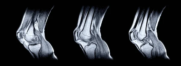 Magnetisk resonanstomografi (Mri) av höger knä. — Stockfoto