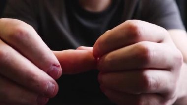 Close view of male hands with strongly bitten nails. Finger selection with alarm. Ugly bitten fingers, cuticles, wounds on the fingers. Bad habit. The concept of onychophagy and dermatophagy.