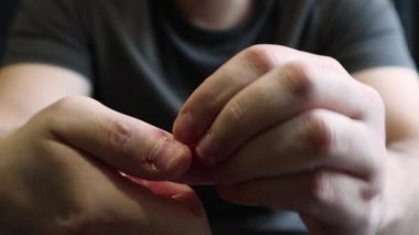 Close view of male hands with strongly bitten nails. Finger selection with alarm. Ugly bitten fingers, cuticles, wounds on the fingers. Bad habit. The concept of onychophagy and dermatophagy.