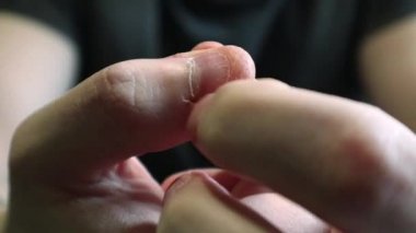 Close view of male hands with strongly bitten nails. Finger selection with alarm. Ugly bitten fingers, cuticles, wounds on the fingers. Bad habit. The concept of onychophagy and dermatophagy.