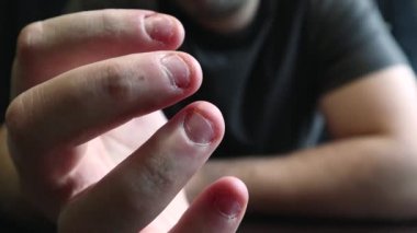 Close view of male hands with strongly bitten nails. Finger selection with alarm. Ugly bitten fingers, cuticles, wounds on the fingers. Bad habit. The concept of onychophagy and dermatophagy.