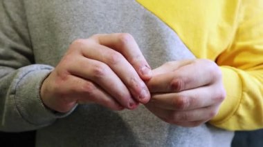 Ugly ugryzienie fingers, biting nails, cuticles, wounds on the fingers. Nail-biting habit. The concept of onychophagy. unattended nail, cracked skin, bad nail grooming.