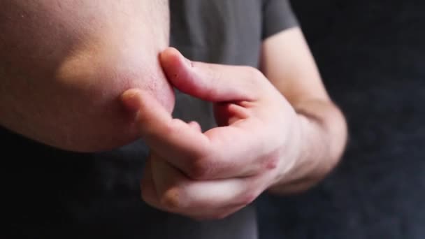 Man Scratches Rough Patch Skin His Elbow Seasonal Skin Problem — Stockvideo